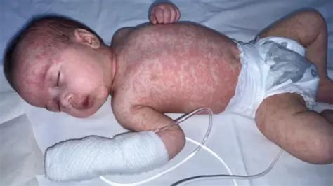 Measles In Black Babies