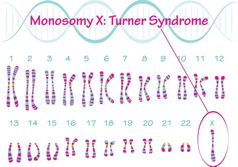 Turner Syndrome Monosomy X
