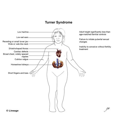 Turner Syndrome Wikipedia